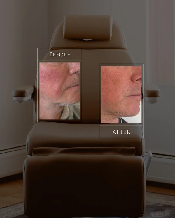 Nasolabial Filler(1) 2