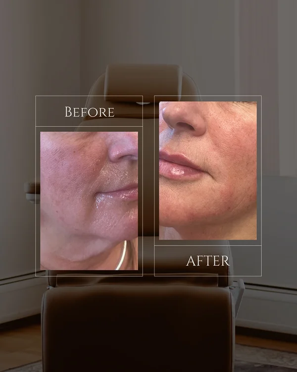 Nasolabial & Lip Filler 1