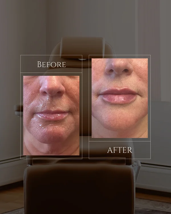 Nasolabial & Lip Filler(1) 1