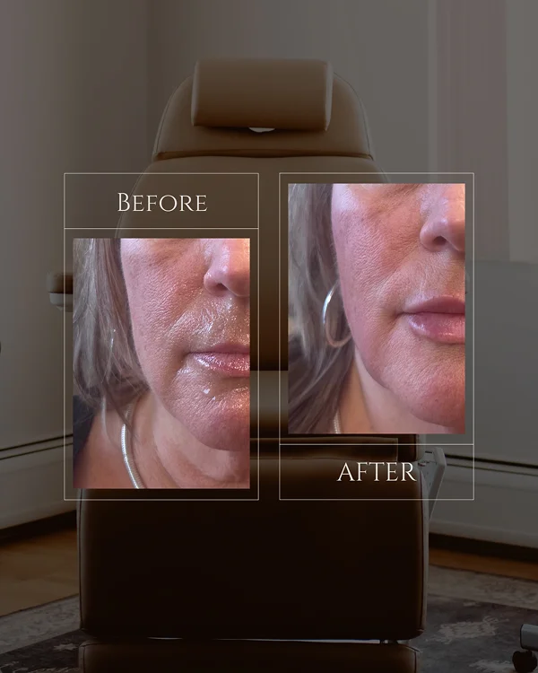 Nasolabial & Lip Filler(2) 1
