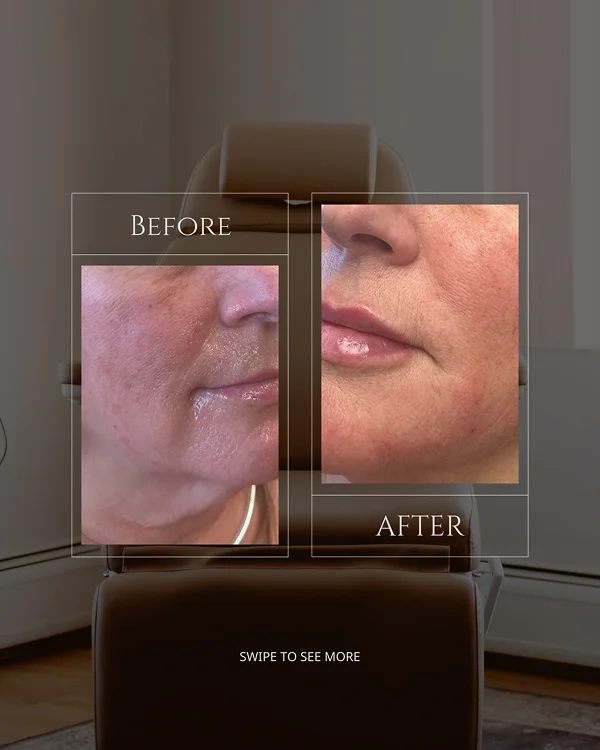 Nasolabial & Lip Filler(3) 1