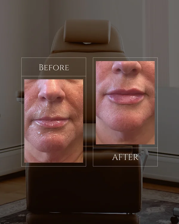 Nasolabial & Lip Filler(4) 1