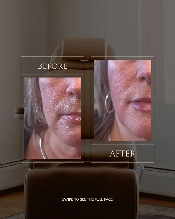 Nasolabial & Lip Filler(5) 1