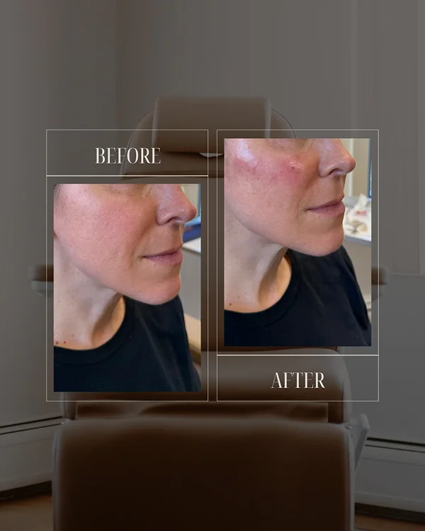 Nasolabial & Mid Face Filler 1
