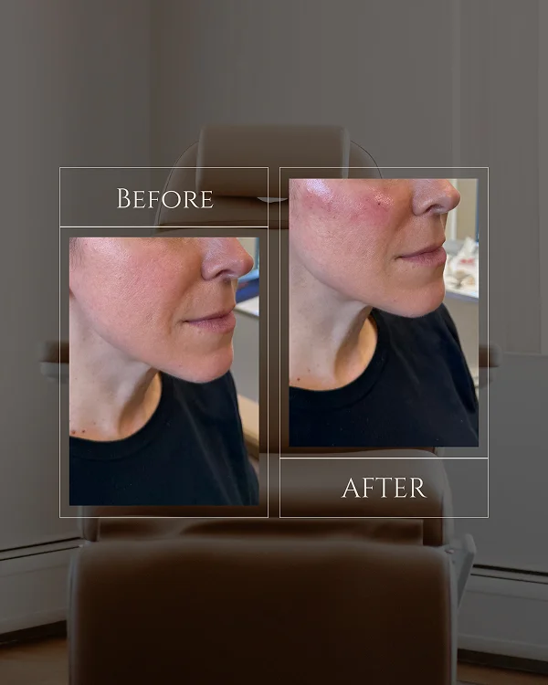Nasolabial & Mid Face Filler(1) 1
