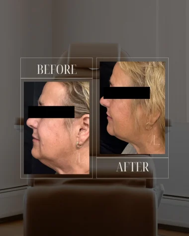 JLUXE BEFORE & AFTER (MORPHEUS face & neck 2)