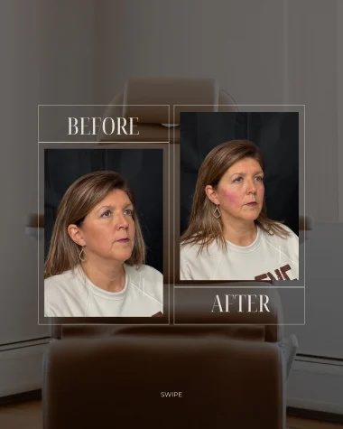 JLUXE BEFORE & AFTER TEMPLATE (Dermal Filler - Mid face 2)