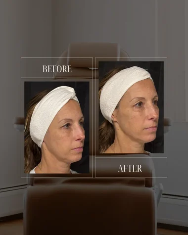JLUXE BEFORE AND AFTER TEMPLATE (Dermal Filler - Facial Rebalancing 3)