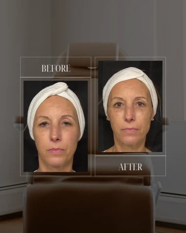 JLUXE BEFORE AND AFTER TEMPLATE (Dermal Filler - Facial rebalancing 2)