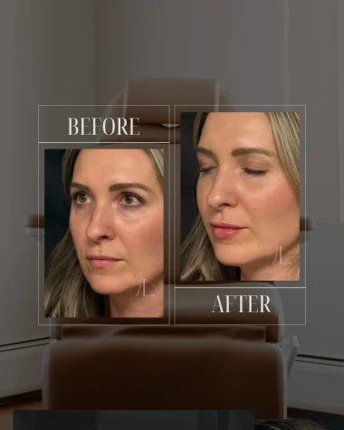 JLUXE BEFORE AND AFTER TEMPLATE (Dermal Filler Lips 1)