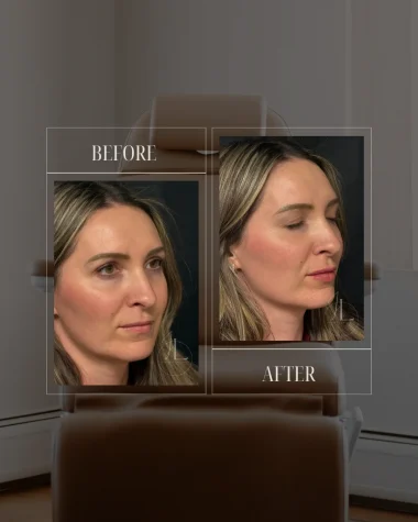 JLUXE BEFORE AND AFTER TEMPLATE (Dermal Filler Lips 2). png
