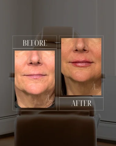 JLUXE BEFORE AND AFTER TEMPLATE (Dermal Filler Lips 3)