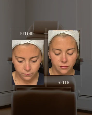 JLUXE BEFORE AND AFTER TEMPLATE (Dermal Filler - facial rebalancing 1a.)
