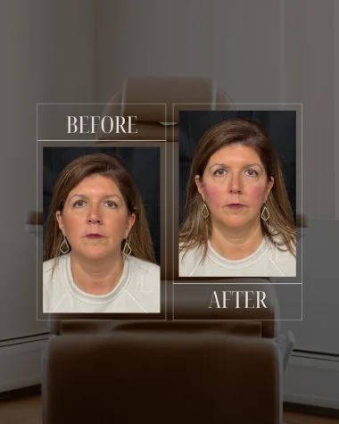JLUXE BEFORE AND AFTER TEMPLATE (Dermal Filler - mid face)