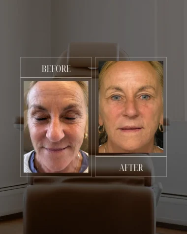 JLUXE BEFORE AND AFTER TEMPLATE (MORPHEUS - face)