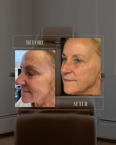 JLUXE BEFORE AND AFTER TEMPLATE (MORPHEUS - face 2)