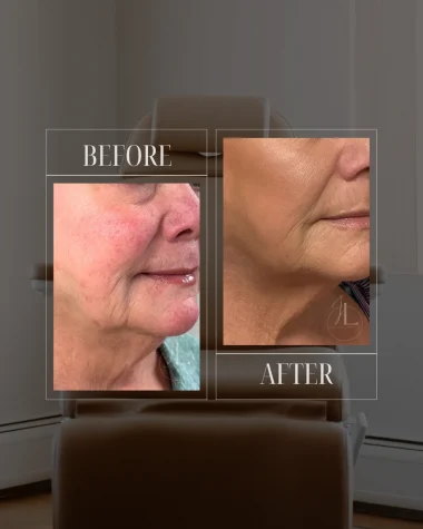 JLUXE BEFORE AND AFTER TEMPLATE (MORPHEUS - face & neck)