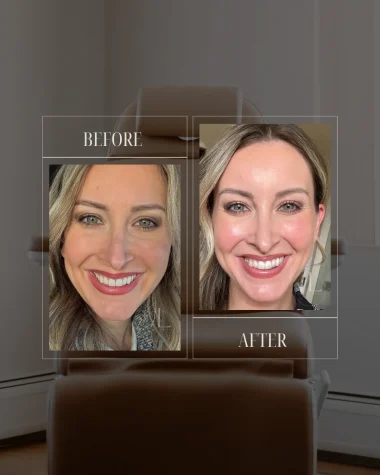 JLUXE BEFORE AND AFTER TEMPLATE (Morpheus - face + Lumecca IPL Laser